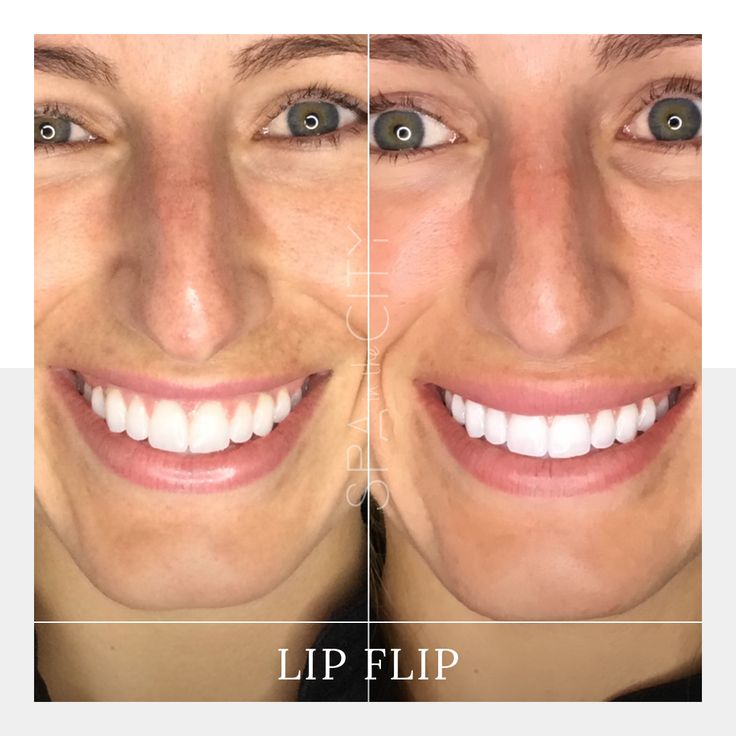 lip flip before and after